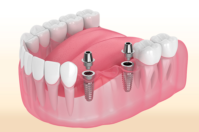 IMPLANT