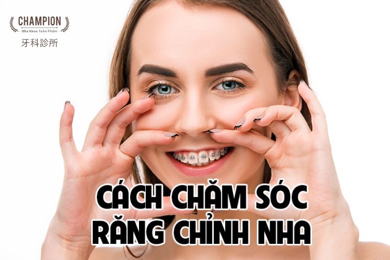 Hướng dẫn cách chăm sóc răng chỉnh nha hiệu quả