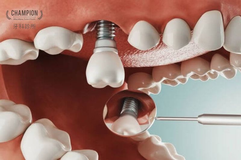 Dịch vụ cấy ghép Implant tại Nha Khoa Champion