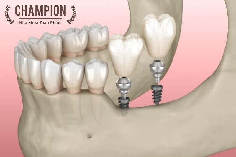 Tất cả mọi điều cần tìm hiểu về cấy ghép mini implant là gì?