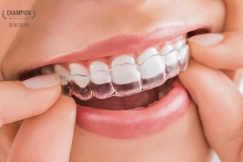 Có nên niềng răng invisalign không? Địa chỉ niềng răng uy tín TP.HCM