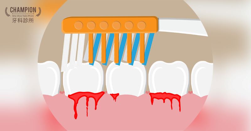 Everything you need to know about periodontal disease and how to treat it.