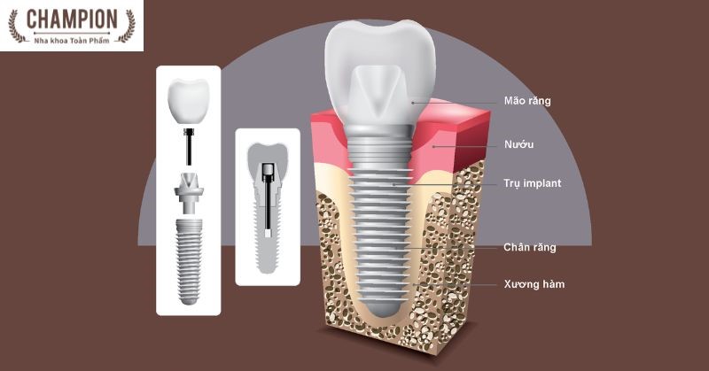 Những điều cần biết về implant nha khoa