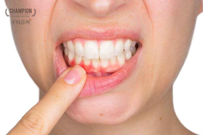 How Can You Prevent a Gum Recession?