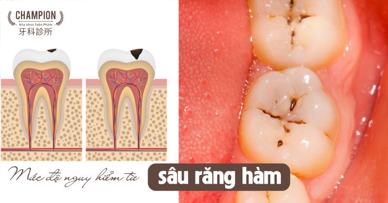 Mức độ nguy hiểm từ sâu răng hàm và hướng giải quyết hiệu quả