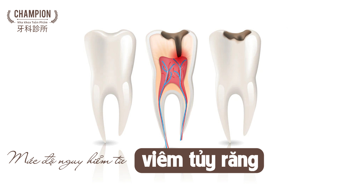 Tình trạng viêm tủy răng là gì? Viêm tủy răng có nguy hiểm không?