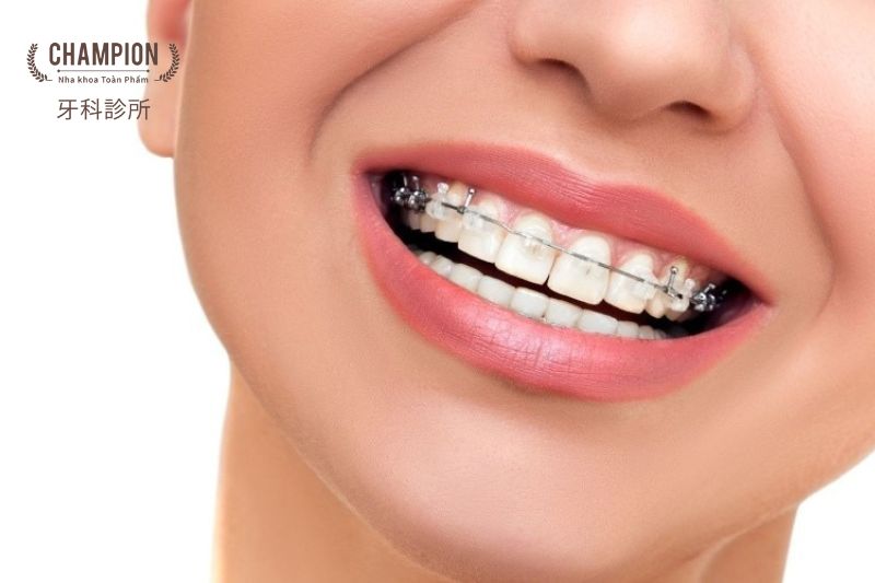 Mách bạn các địa chỉ niềng răng uy tín tại Quận 7 TPHCM