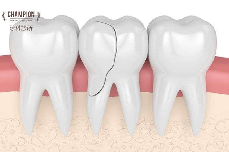 Nứt Răng Là Gì? Nguyên Nhân, Triệu Chứng và Cách Điều Trị