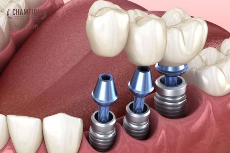 Răng Implant bị lung lay và các giải pháp khắc phục