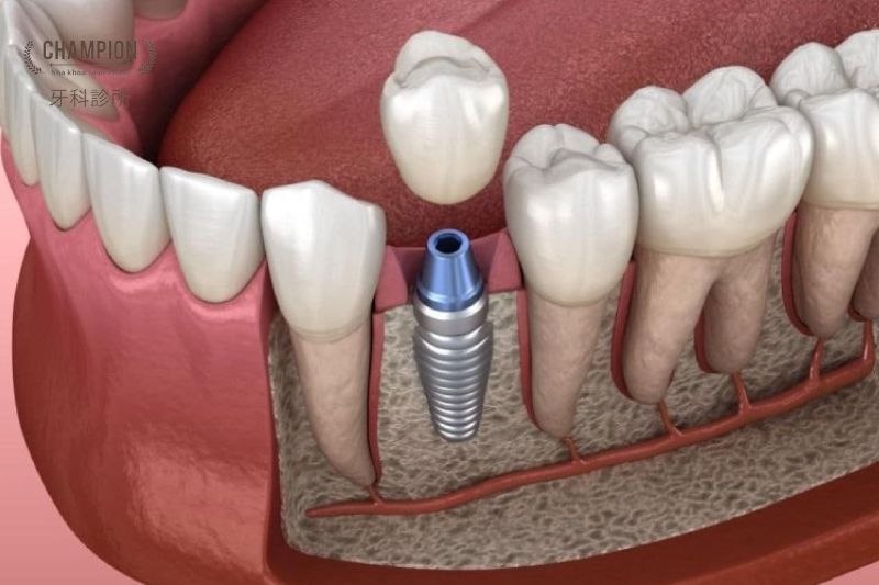 Trồng răng implant ở đâu tốt? Địa chỉ trồng răng Implant uy tín TPHCM