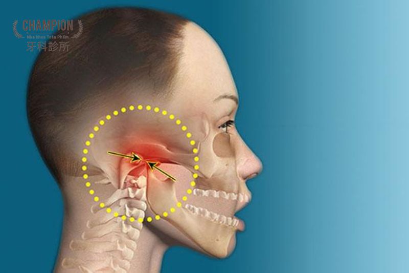 Viêm khớp thái dương hàm là gì? Điều trị như thế nào?