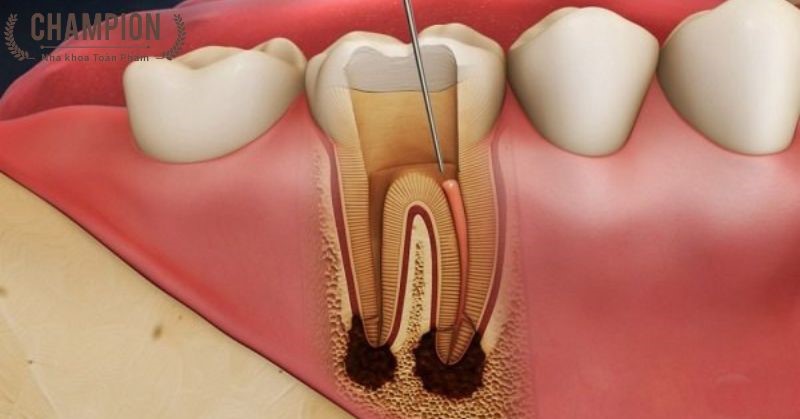 Viêm tủy răng là gì? Cách điều trị hiệu quả nhất hiện nay nhật