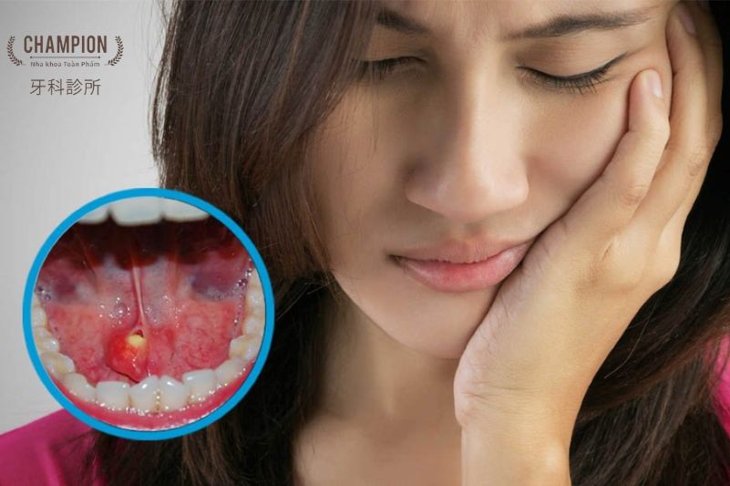 Vôi hóa tuyến nước bọt: Nguyên nhân, triệu chứng và cách điều trị