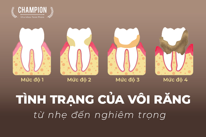 tinh-trang-cua-voi-rang-tu-nhe-den-nghiem-trong