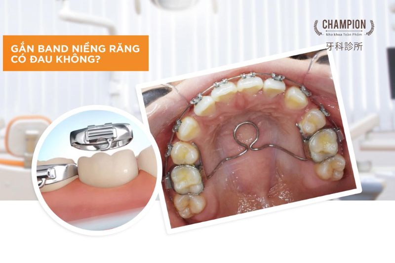 Một số trường hợp không cần lắp band niềng răng?