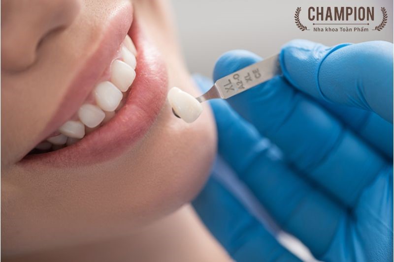 Quy trình bọc răng sứ cố định tại nha khoa Champion