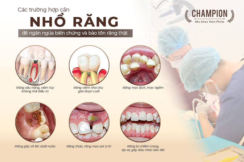 cac-truong-hop-can-nho-rang-de-ngan-ngua-bien-chung-va-bao-ton-rang-that