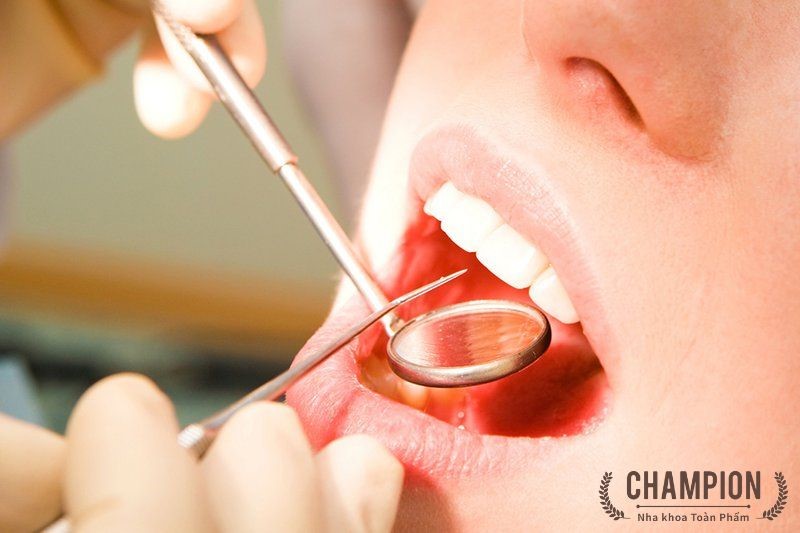 Quy trình cạo vôi răng tại Nha Khoa Champion 