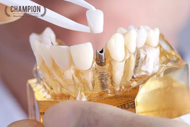 Những yếu tố quyết định thời gian trồng răng Implant mất bao lâu