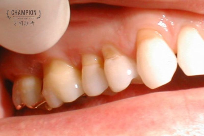 Tại sao cần phải chẩn đoán mòn men răng sớm?