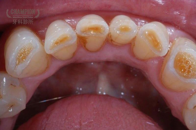 Các phương pháp chẩn đoán mòn men răng chuẩn nhất