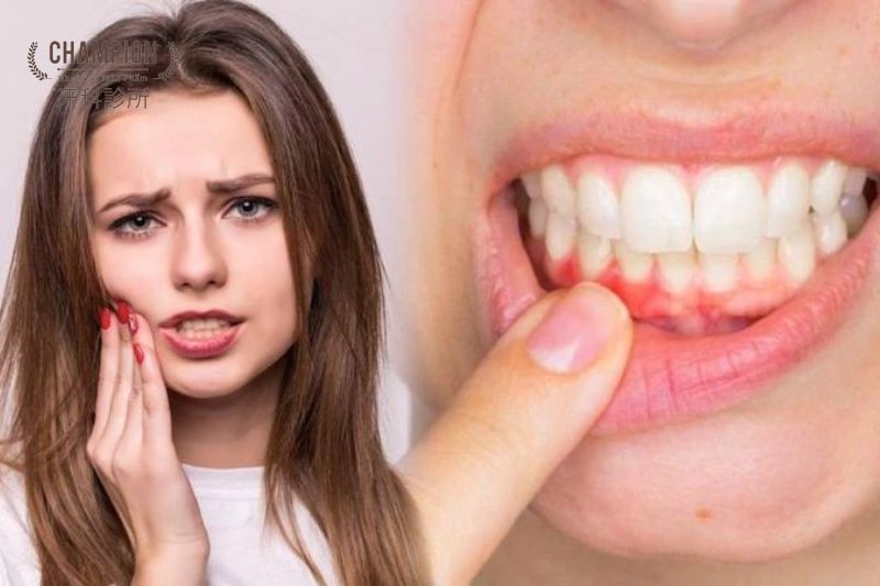 Nguyên nhân phổ biến gây chảy máu chân răng?