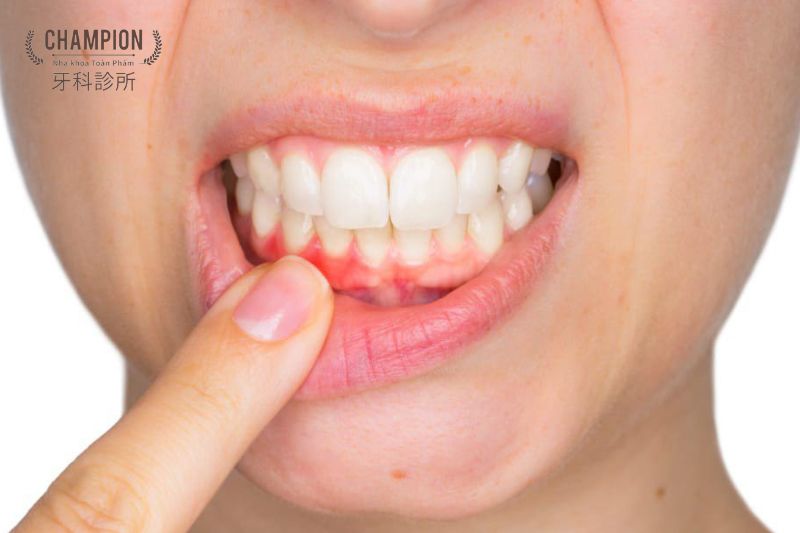 Cách xử trí trong trường hợp chảy máu chân răng