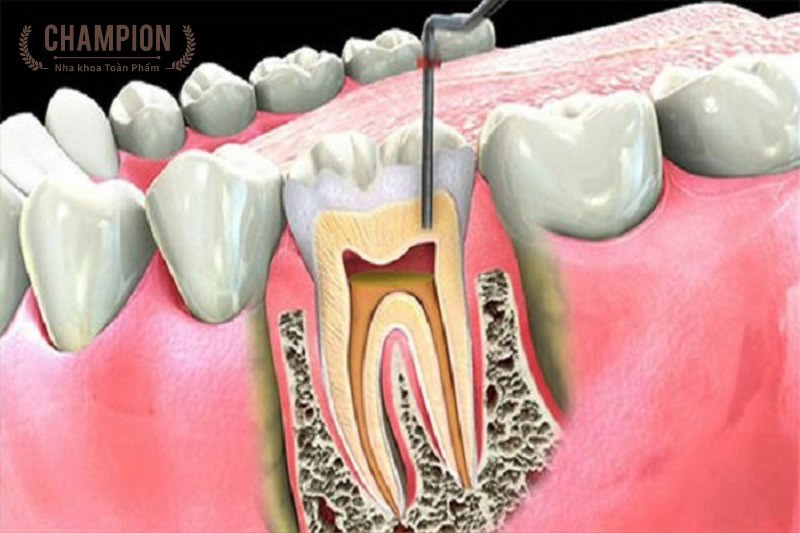 Điều trị tủy răng là gì? 