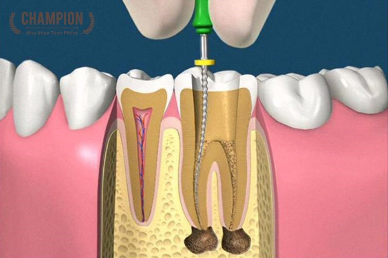 Những trường hợp nào cần chữa tủy răng?