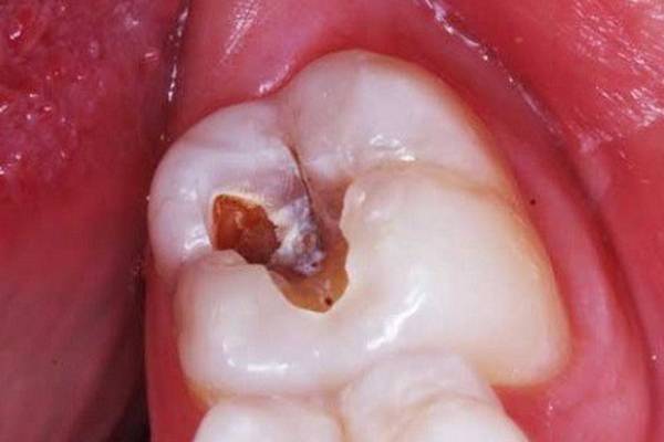 Dấu hiệu sâu răng hàm
