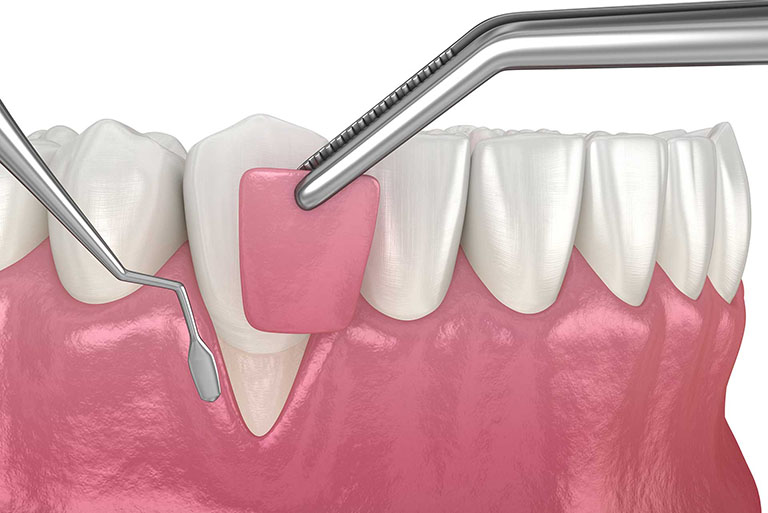 soft tissue graft