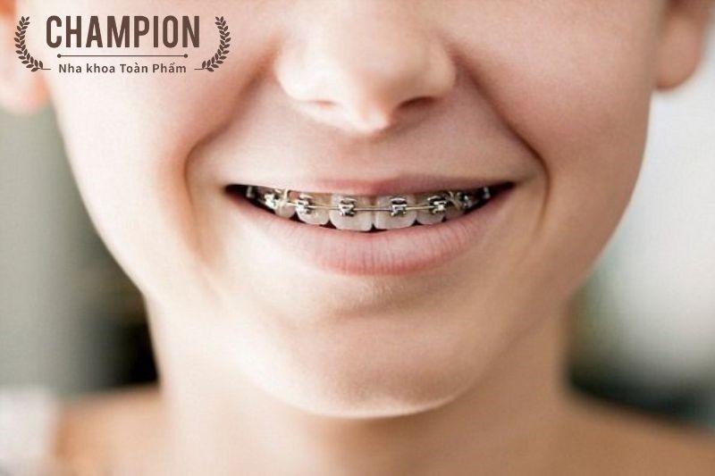 Why use braces?