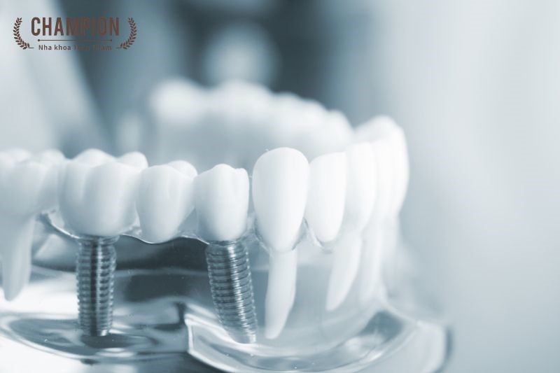 Trồng răng implant có an toàn không?