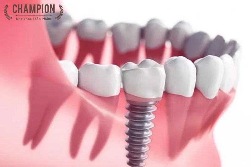 Các giai đoạn của trồng răng Implant Nobel Biocare