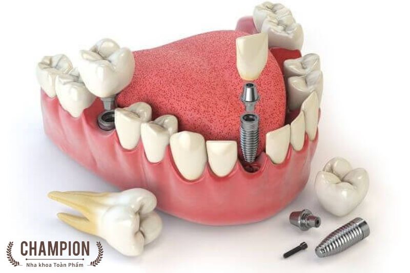 Trồng răng Implant Nobel Biocare là gì?