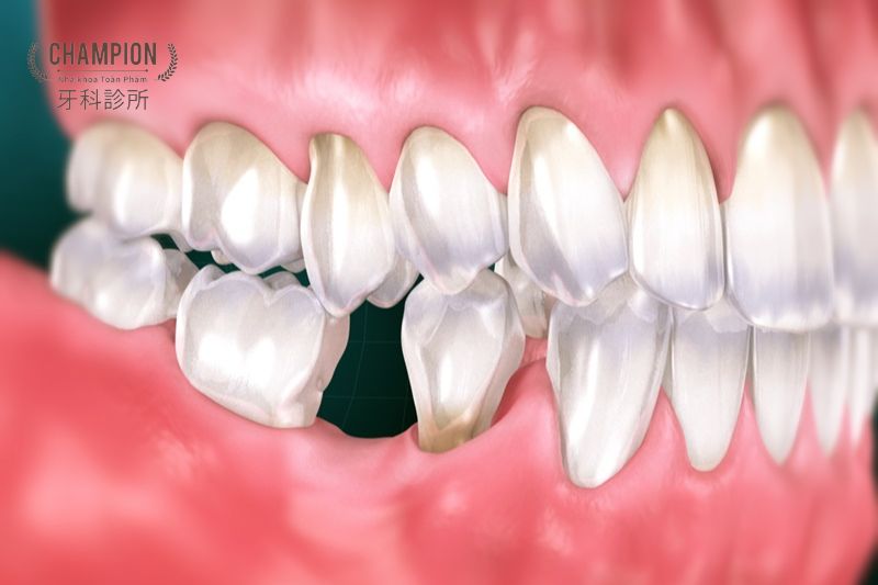Các hậu quả khi không khắc phục kịp thời tình trạng mất răng