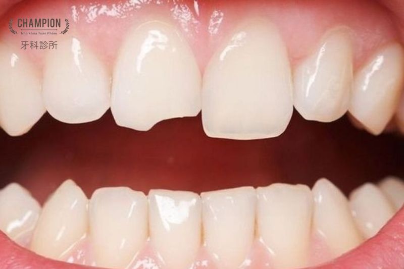 Khi nào cần làm lại răng sứ?