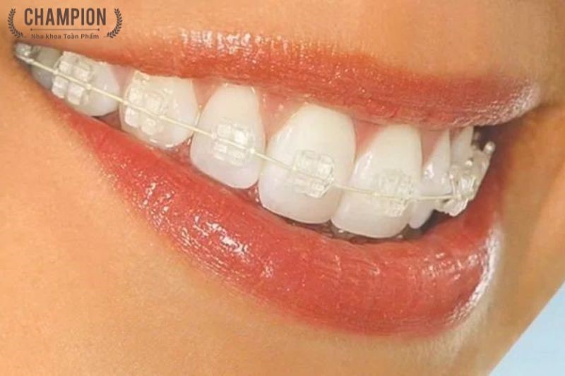 Niềng răng mắc cài pha lê