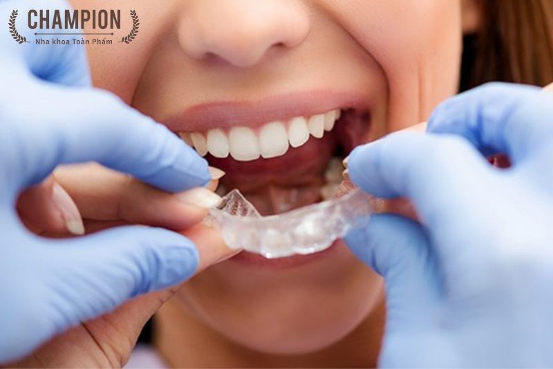 Những lợi ích khi sử dụng máng chống nghiến răng