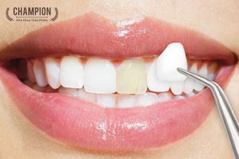 Dán sứ Veneer là gì?