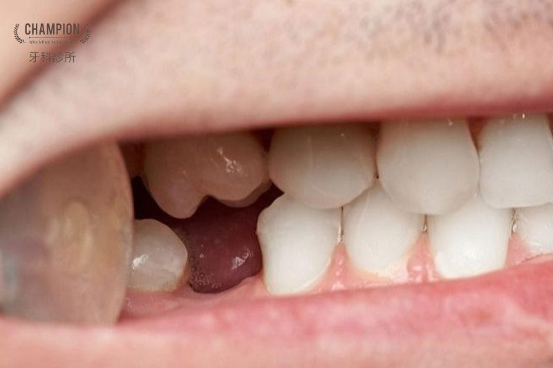 Can you get braces with 6 missing teeth?
