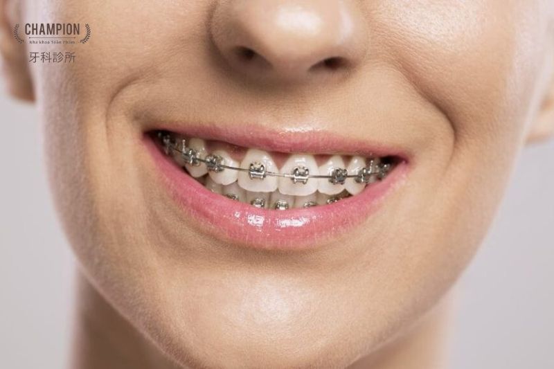 Các phương pháp niềng răng phổ biến khi mất răng số 6