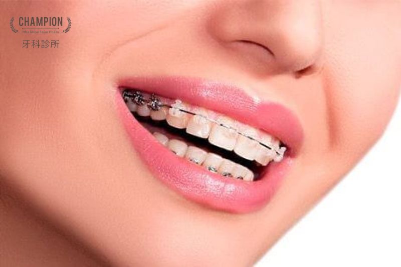 So sánh mặt dán sứ veneer và chỉnh nha ngắn hạn