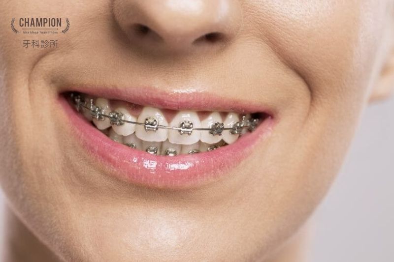 Niềng răng mắc cài kim loại là gì?