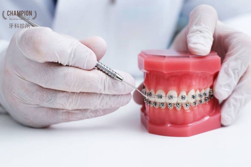 Ưu và nhược điểm của niềng răng mắc cài kim loại