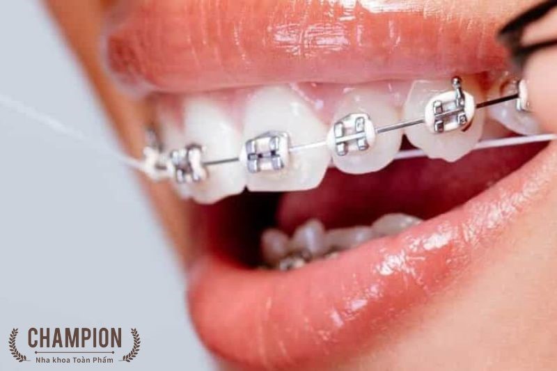 Những trường hợp nào nên niềng răng thẩm mỹ?