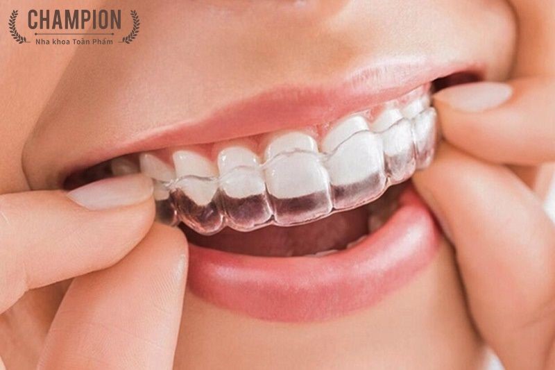 Niềng răng thẩm mỹ là gì? 
