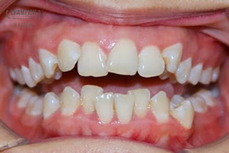 Tác hại của tình trạng răng cửa mọc lệch?