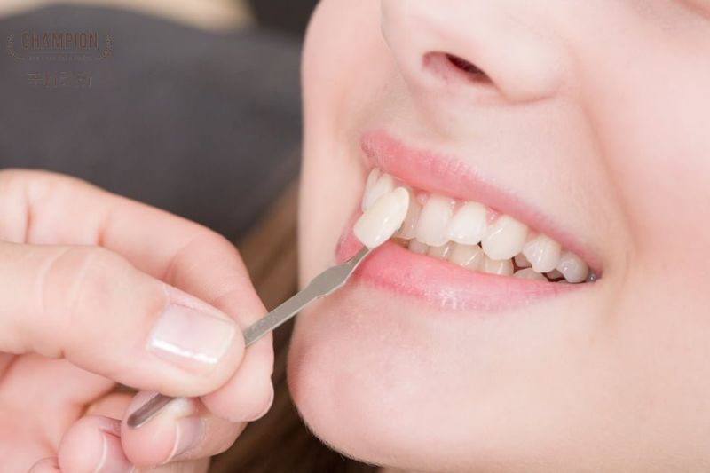 What is Porcelain Veneers?