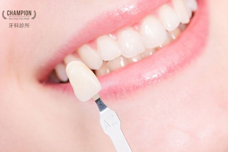 Prominent Advantages of Porcelain veneers